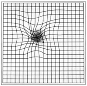 An Amsler grid, as it might be  viewed by a person with age  related macular degeneration.